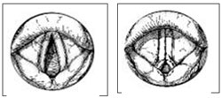Vocal Cord Dysfunction